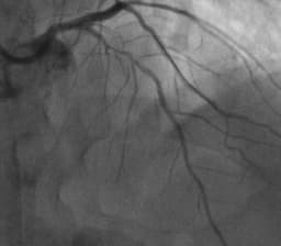 Radiofrequency Ablation Treatment