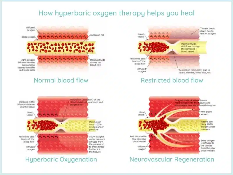 How HBOT Works