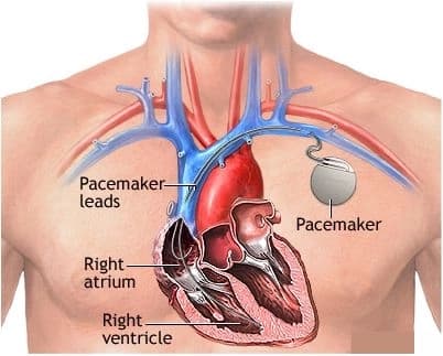 Heart Pacemaker Device