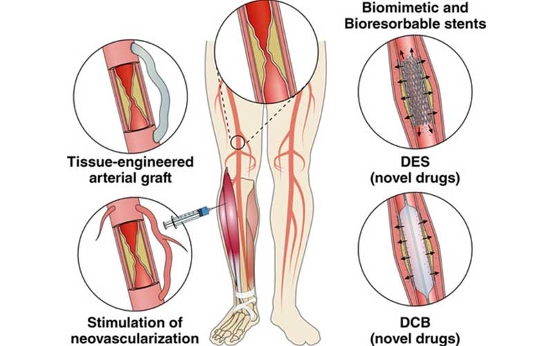 Below Knee Artery Angioplasty