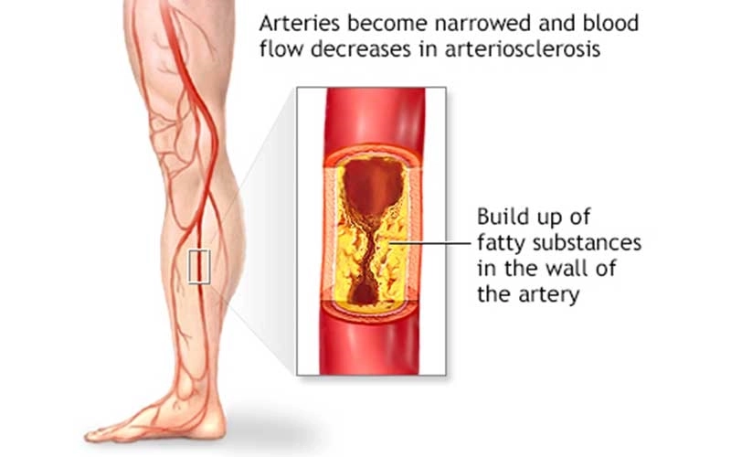 Femoral Artery Angioplasty