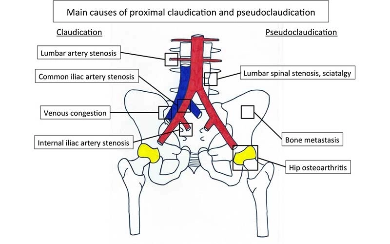 Iliac Artery Angioplasty