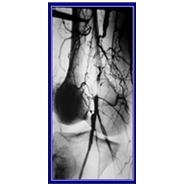 Below Knee Artery Angioplasty