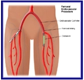 Femoral Artery Angioplasty