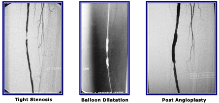 Short Discrete Stenosis of the Femoral Artery