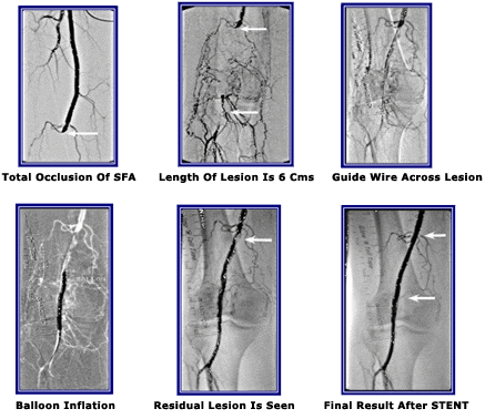 Chronic Total Occlusion Of The Superficial Femoral Artery
