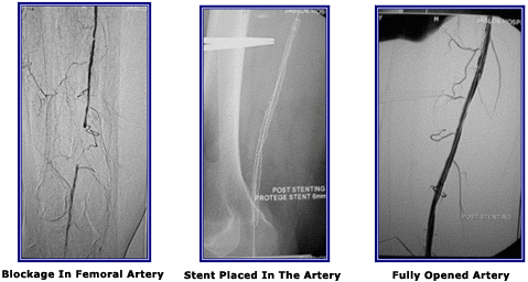 Stenting For Short Segment Femoral Artery Occlusion