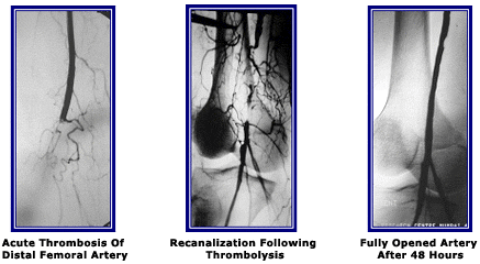 Thrombolytic for Acute Distal Femoral Artery Occlusion