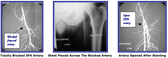 Sudden Total Occlusion of Origin Of Femoral Artery
