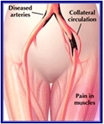 Iliac Artery Angioplasty