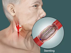 Understanding Carotid Angioplasty