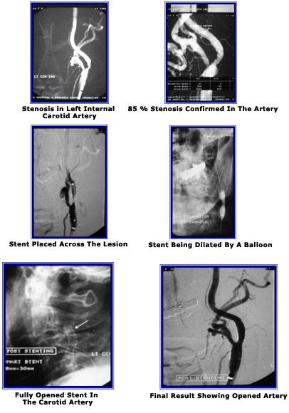 Preventing Stroke In An 85-Year-Old Man