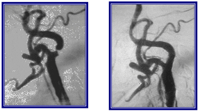 Case of Recurrent Stroke