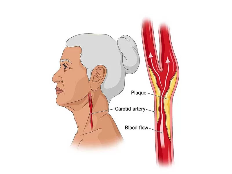 Carotid Angioplasty Treatment