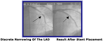 Discrete Stenosis of the Left Anterior Descending Artery (LAD)
