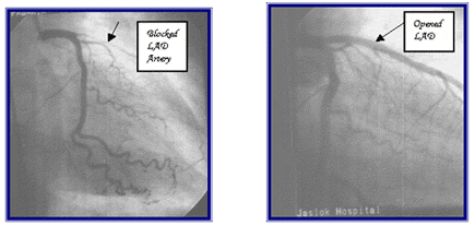 Emergency Angioplasty During Acute Heart Attack