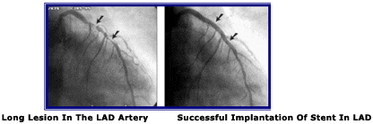 Long Segment Disease of LAD