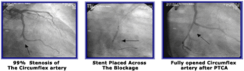 Subtotal 99% Stenosis of Distal Circumflex Artery