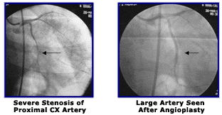 Severe Stenosis of the Proximal Circumflex Artery