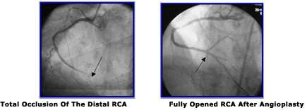 Total Occlusion of Distal Right Coronary Artery (RCA)