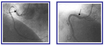 Complete Stenosis of Proximal Right Coronary Artery