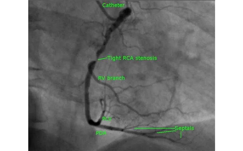 Severe RCA Stenosis in High-Risk Diabetic Patient
