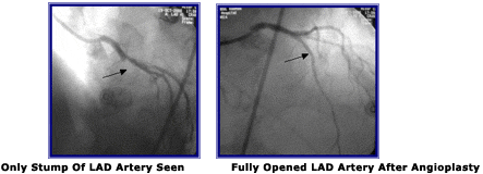 Angioplasty After Failed Bypass Surgery