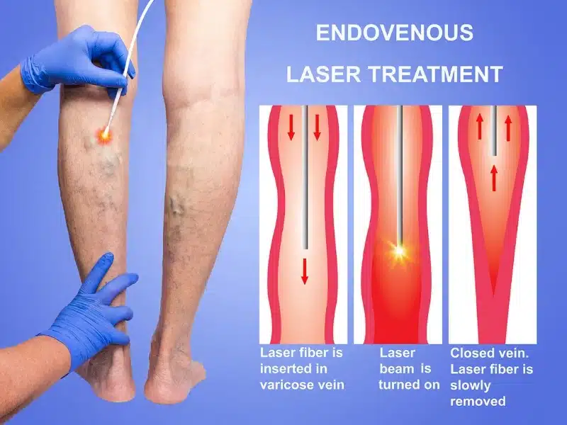 Varicose Veins Treatment: Laser Ablation Therapy - VIVAA