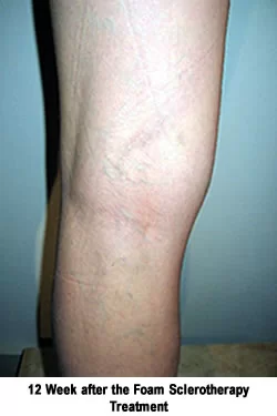 SCLEROTHERAPY- A MEDICAL PROCEDURE TO ELIMINATE VARICOSITIES AND ABNORMAL  VEINS